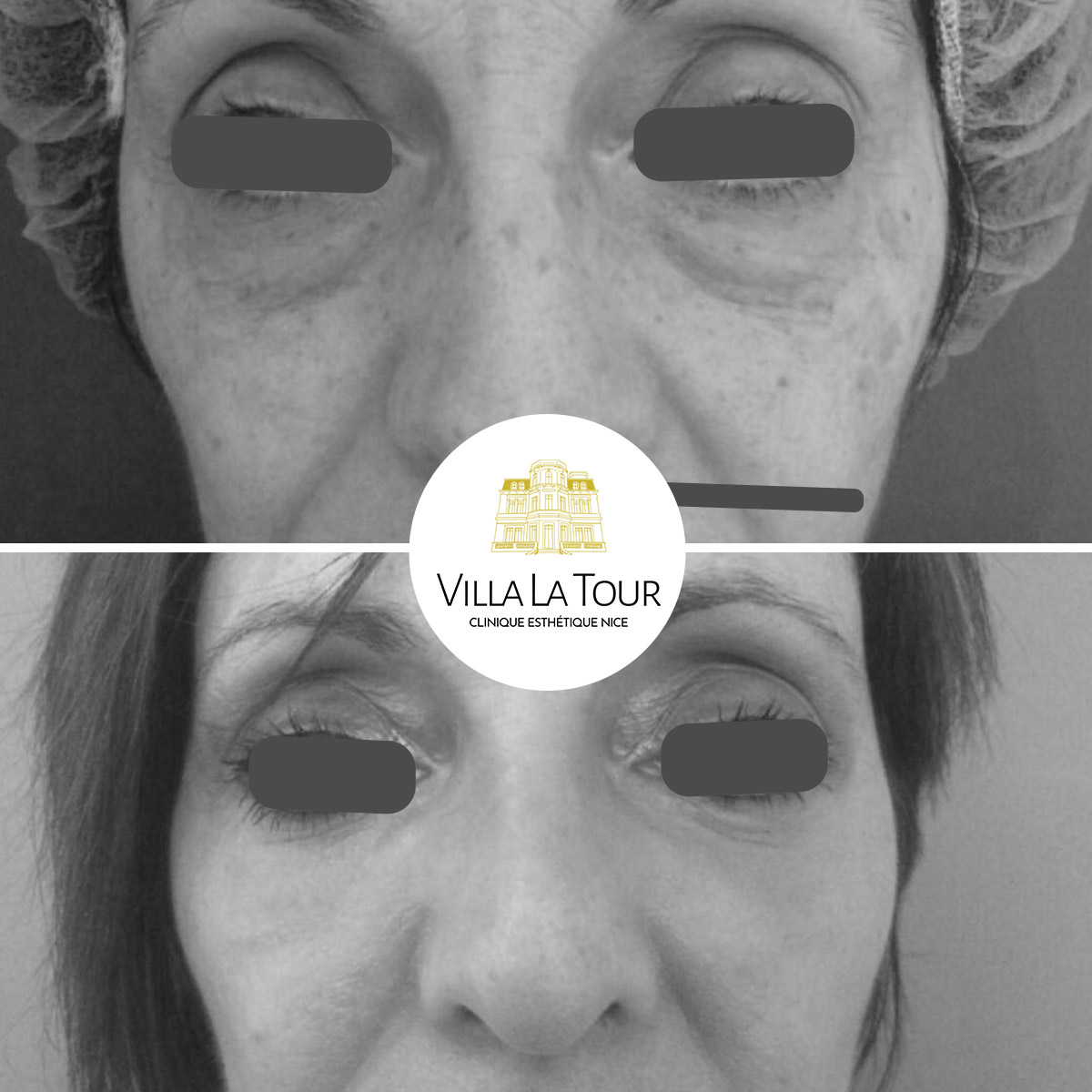 Blepharoplastie des paupières inférieures, exérèse de l'excès de graisse au laser , et resurfacing de la peau par peeling moyen