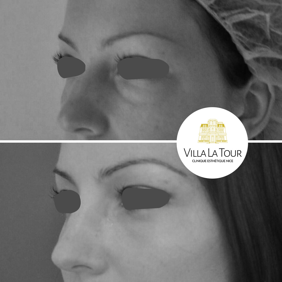 Blepharoplastie des paupières inférieures par extraction de poches de graisses et resurfacing de la peau au laser CO2 fractionné