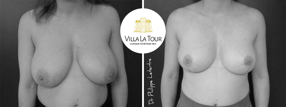 Réduction mammaire Clinique Villa La Tour