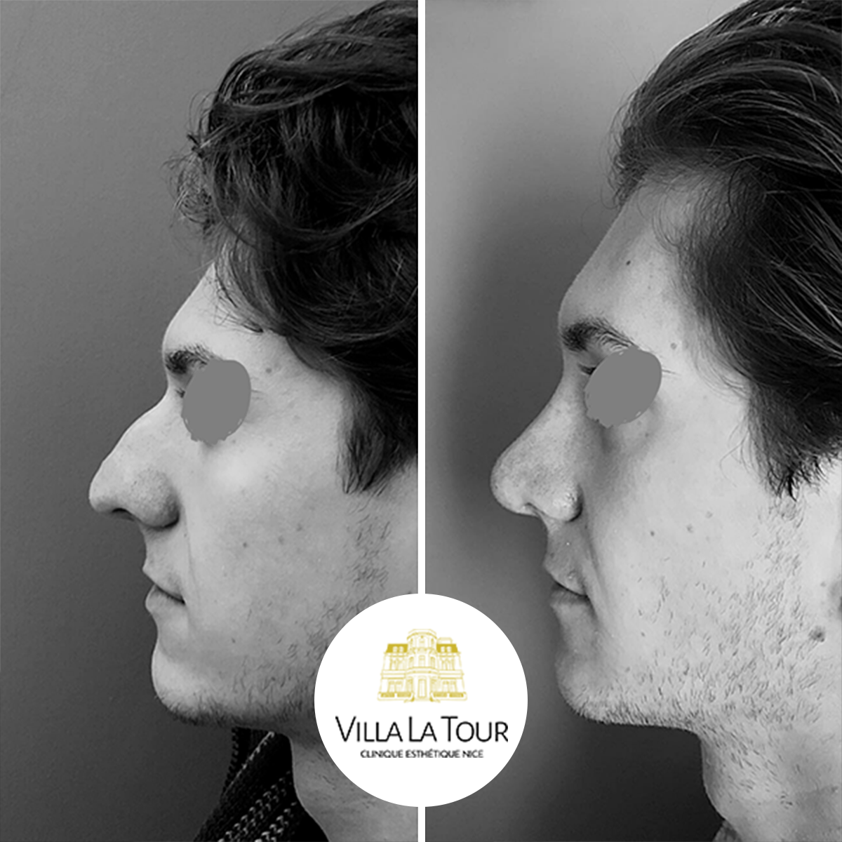 Rhinoplastie chirurgie du nez photo avant-apres