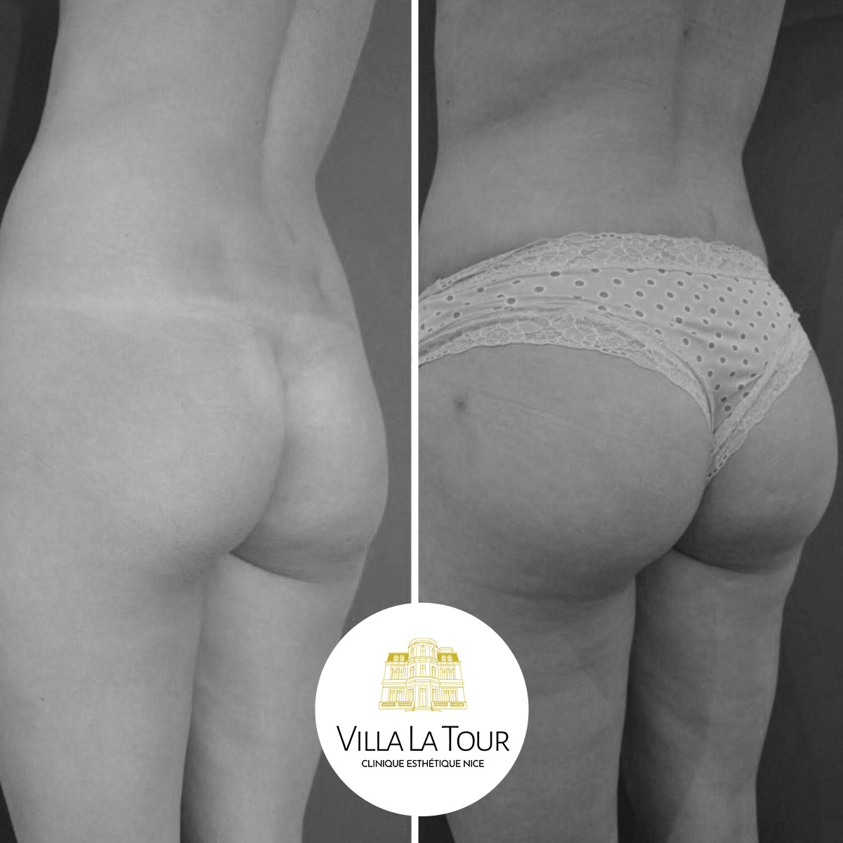 Lipofilling des fesses Clinique Villa La Tour