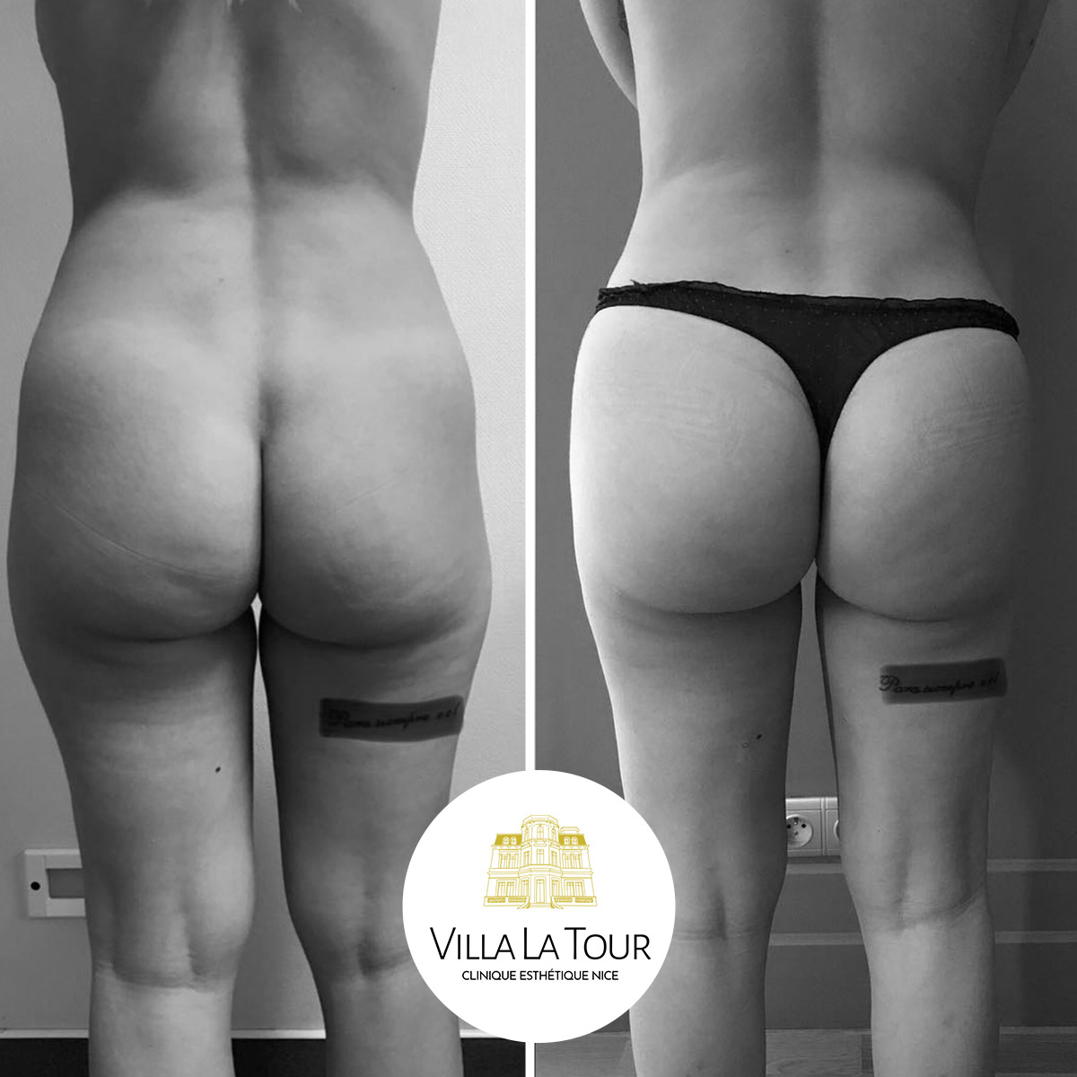 Lipofilling des fesses Clinique Villa La Tour