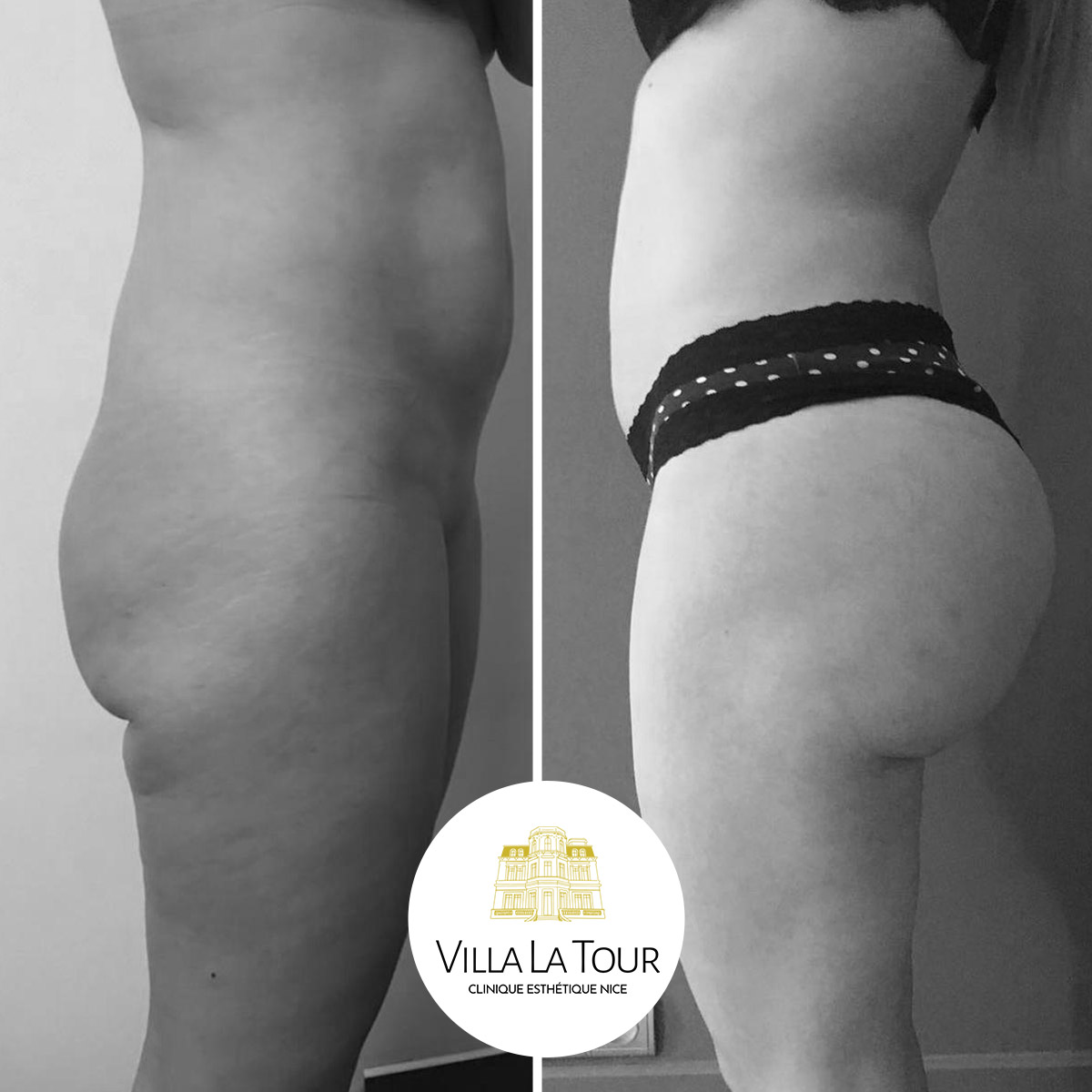 Lipofilling des fesses Clinique Villa La Tour